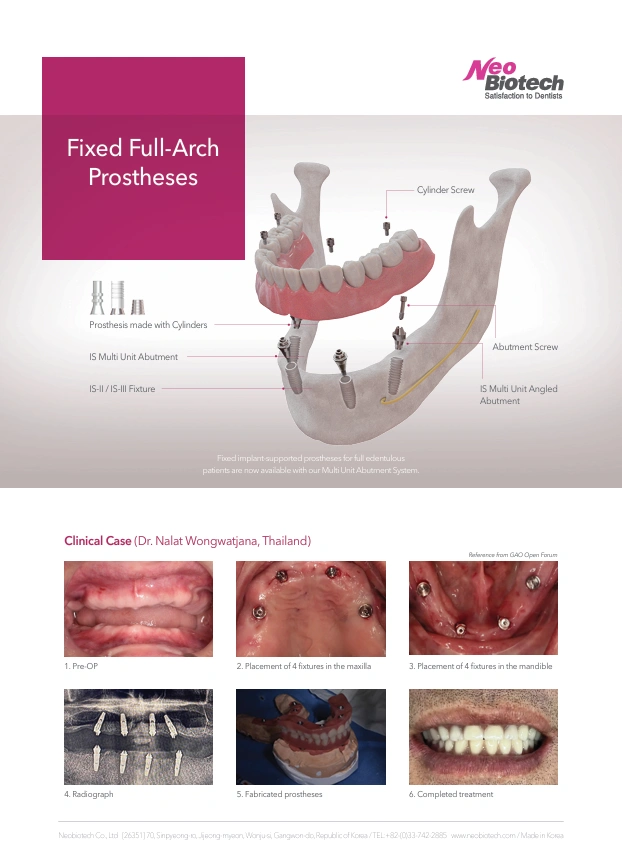 FIXED FULL-ARCH PROSTHESIS